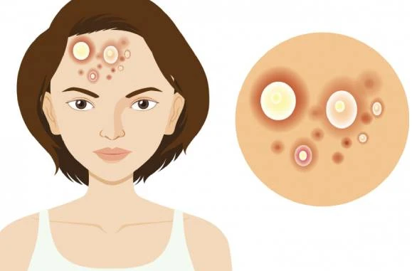 Illustration of a woman with acne on her forehead. Enlarged view on the right shows various pimple types. Tone is informational with a medical focus.