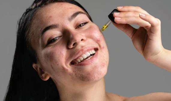Smiling woman with acne applying facial oil dropper, skincare routine on gray background.
