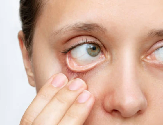Person pulls down lower eyelid, showing inner eye.