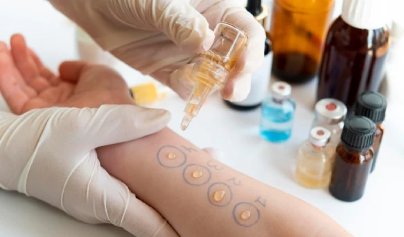 A medical professional in gloves applies drops to a patient's forearm for an allergy test. Numbered circles guide the procedure. Vials and bottles sit nearby.