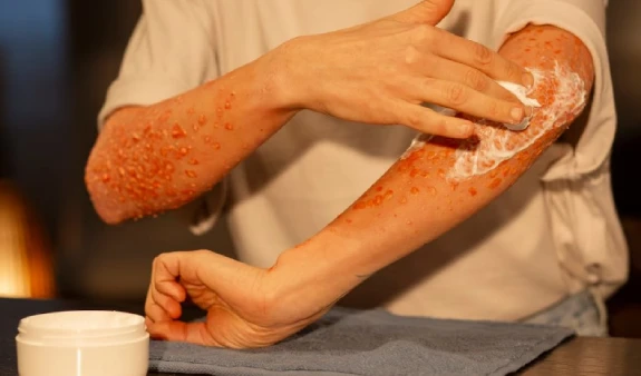 A person applies cream to forearms with red, inflamed spots, indicative of a skin condition. The setting is warm and focused, suggesting care and relief.