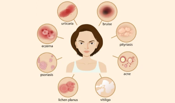 Illustration of a woman surrounded by images of skin conditions: urticaria, bruise, pityriasis, acne, vitiligo, lichen planus, psoriasis, and eczema.