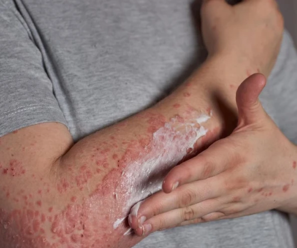 A person applies cream to a red, irritated rash on their forearm, wearing a gray shirt. The action suggests care and relief for the inflamed skin.