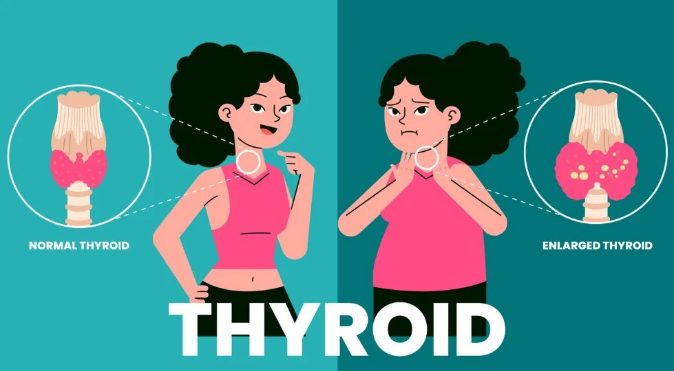 Illustration of normal vs enlarged thyroid in women.