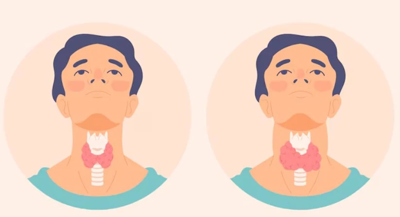 Illustration of neck anatomy showing thyroid size differences.